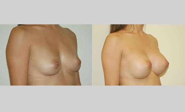 Breast Augmentation: Image #5