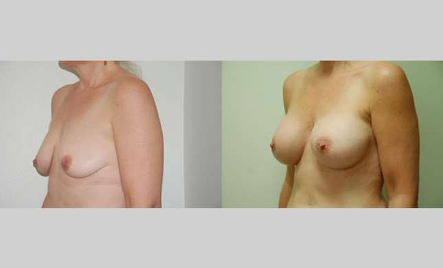 Breast Augmentation: Image #50