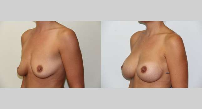 Breast Augmentation: Image #500
