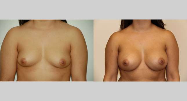 Breast Augmentation: Image #501