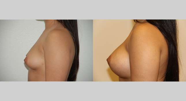 Breast Augmentation: Image #502