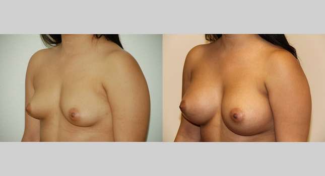 Breast Augmentation: Image #503
