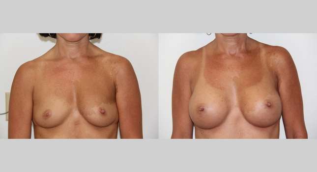 Breast Augmentation: Image #504