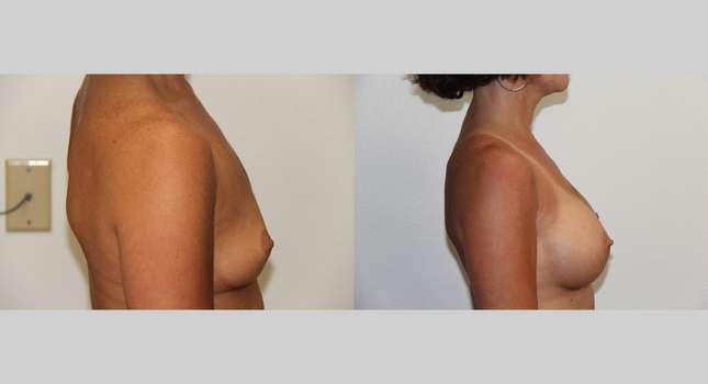 Breast Augmentation: Image #505