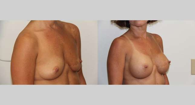 Breast Augmentation: Image #506