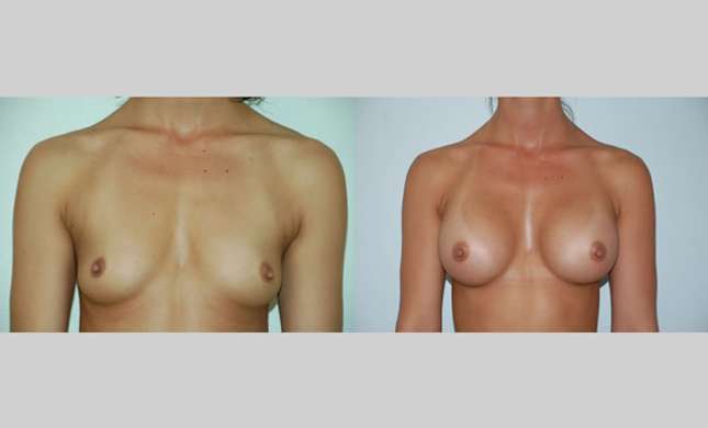 Breast Augmentation: Image #51