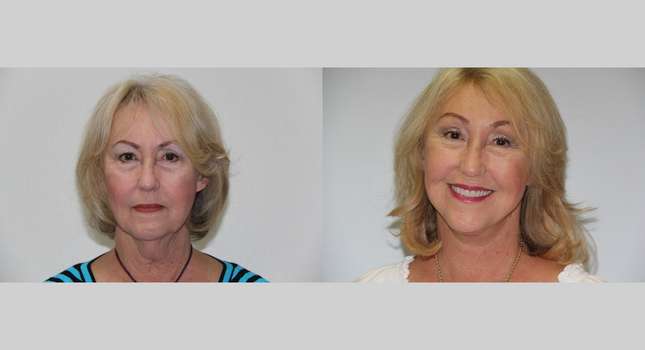 Facial Rejuvenation: Image #511