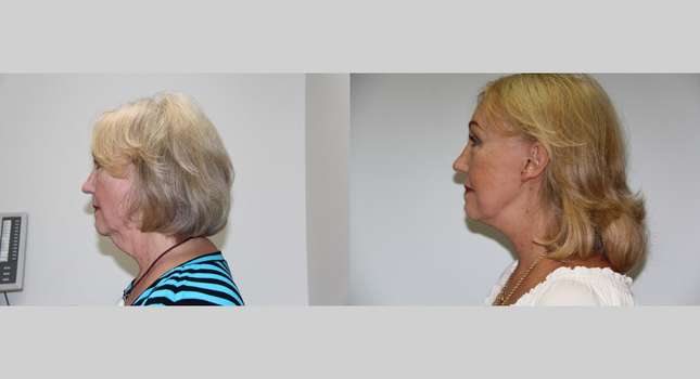 Facial Rejuvenation: Image #512