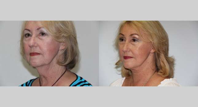 Facial Rejuvenation: Image #513