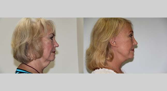 Facial Rejuvenation: Image #514