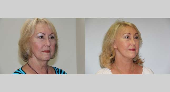 Facial Rejuvenation: Image #515