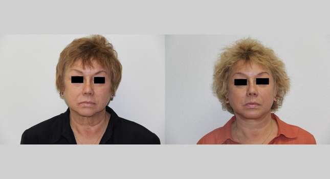 Facial Rejuvenation: Image #516