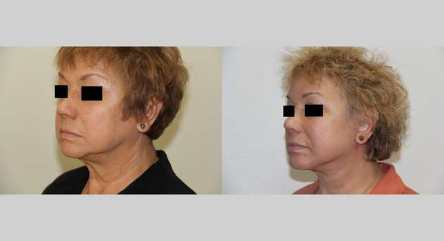 Facial Rejuvenation: Image #517