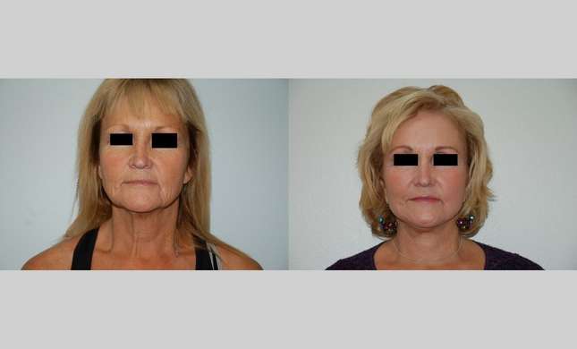 Facial Rejuvenation: Image #518