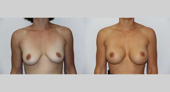 Breast Augmentation: Image #519