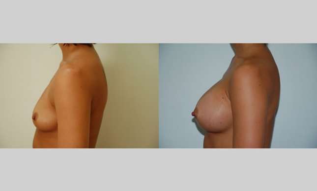 Breast Augmentation: Image #52