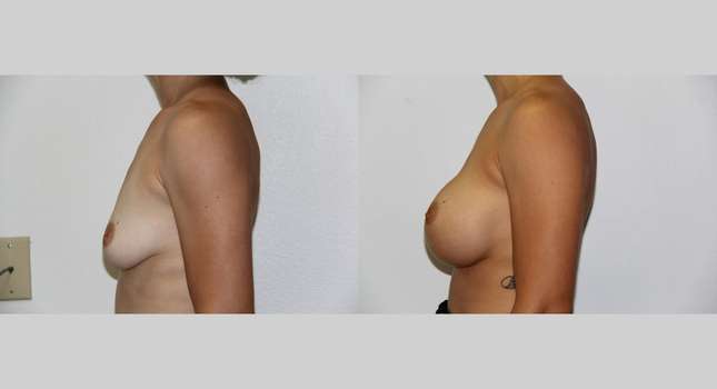 Breast Augmentation: Image #520