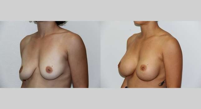 Breast Augmentation: Image #521