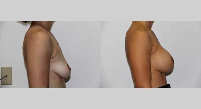 Breast Augmentation: Image #522