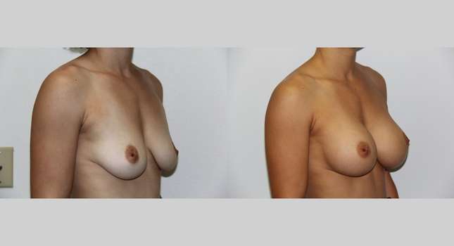Breast Augmentation: Image #523