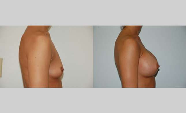 Breast Augmentation: Image #53