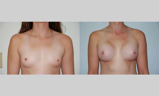 Breast Augmentation: Image #54