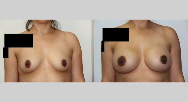 Breast Augmentation: Image #542