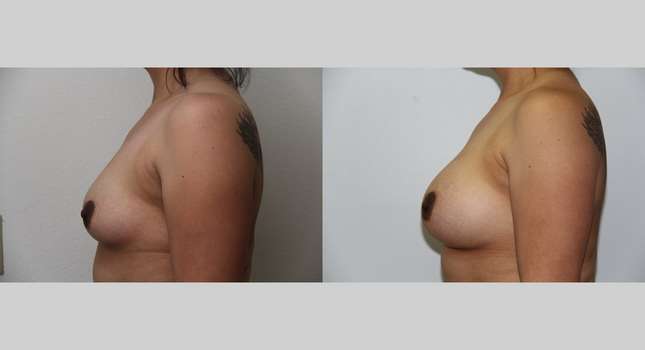 Breast Augmentation: Image #543