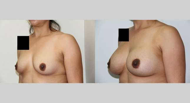 Breast Augmentation: Image #544