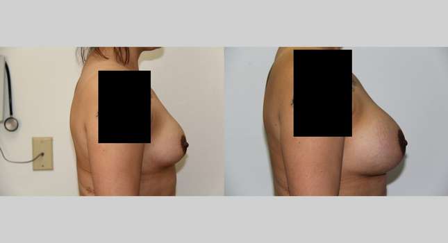 Breast Augmentation: Image #545
