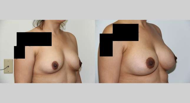 Breast Augmentation: Image #546