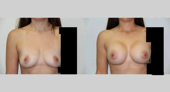 Breast Augmentation: Image #547