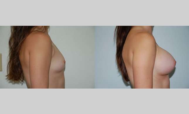 Breast Augmentation: Image #55