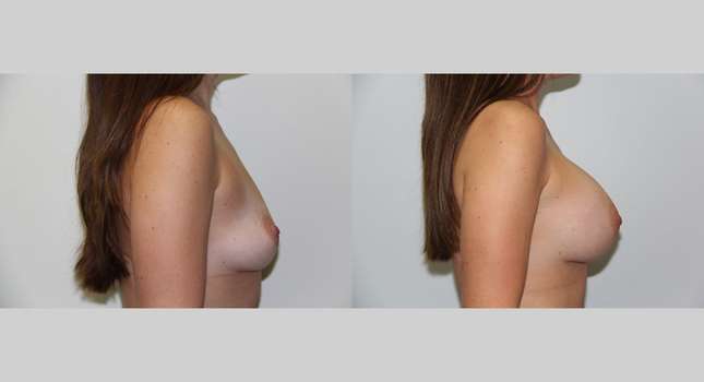 Breast Augmentation: Image #550