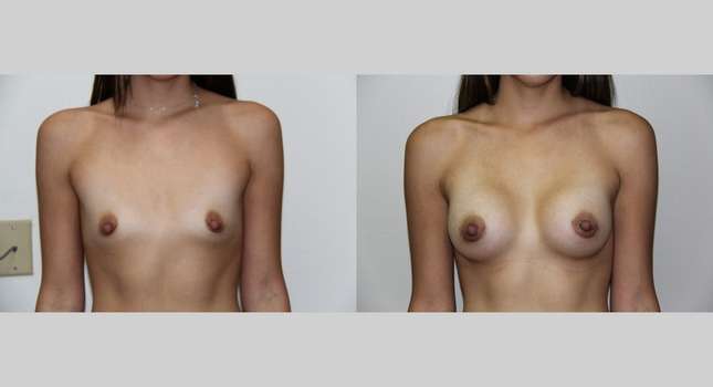 Breast Augmentation: Image #556