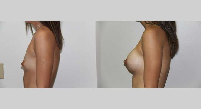 Breast Augmentation: Image #557