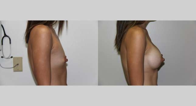 Breast Augmentation: Image #559
