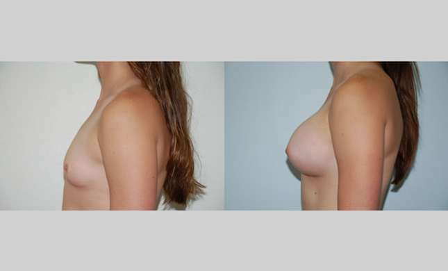 Breast Augmentation: Image #56