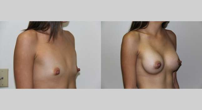 Breast Augmentation: Image #560
