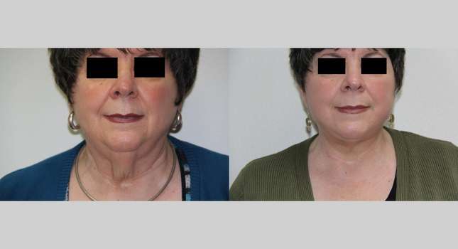 Facial Rejuvenation: Image #567