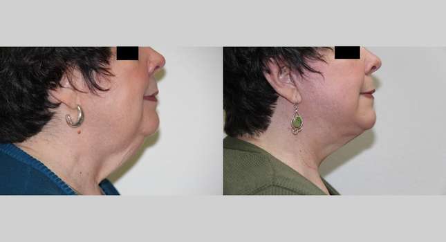Facial Rejuvenation: Image #568