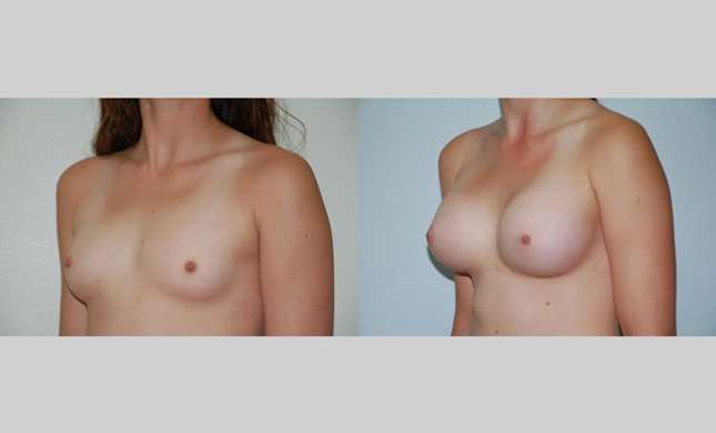 Breast Augmentation: Image #57