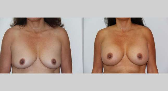 Breast Augmentation: Image #574