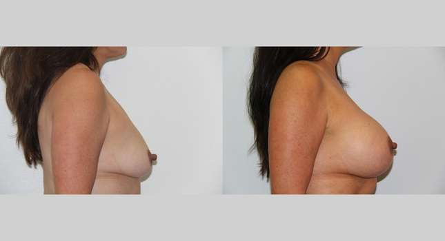 Breast Augmentation: Image #575