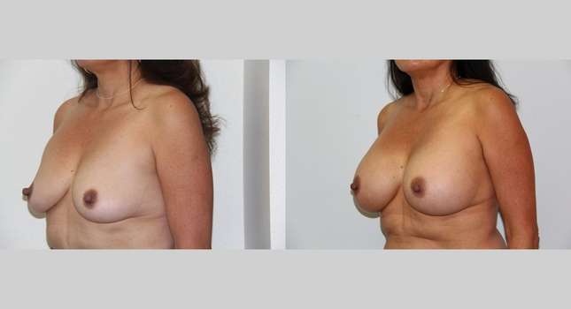 Breast Augmentation: Image #576