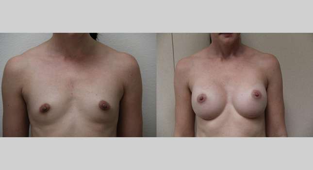 Breast Augmentation: Image #577
