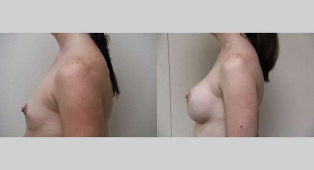 Breast Augmentation: Image #578