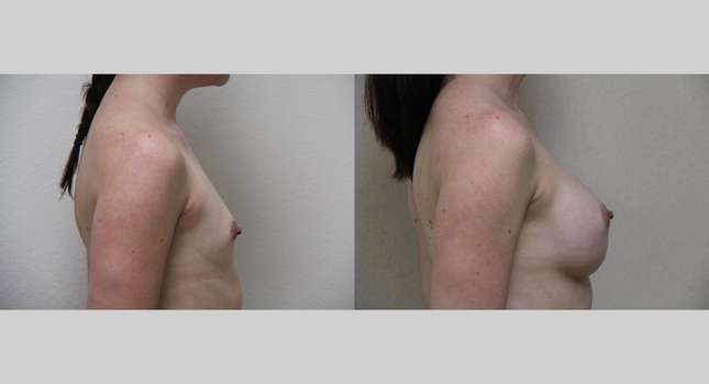 Breast Augmentation: Image #579