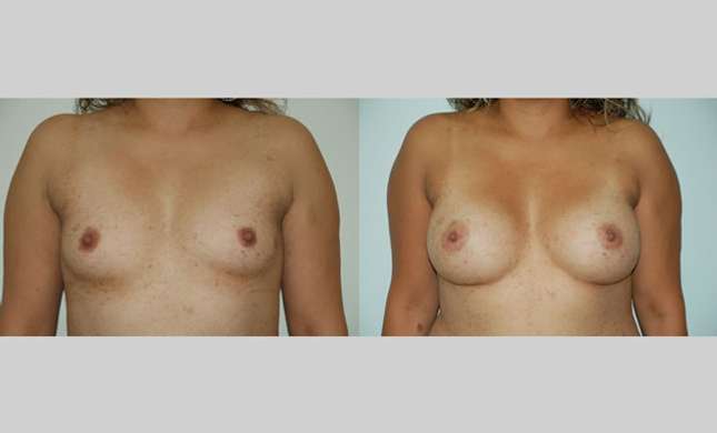 Breast Augmentation: Image #58