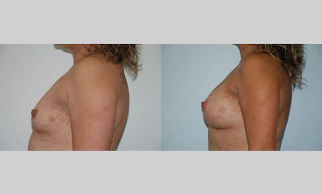 Breast Augmentation: Image #59